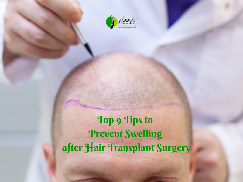 Top 9 Tips to Prevent Swelling after Hair Transplant Surgery