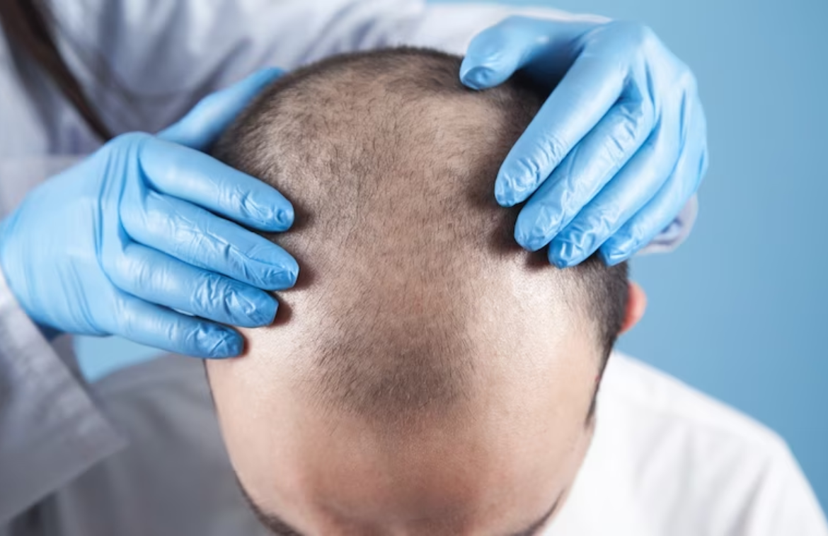Suffering hair loss? A hair transplant is a lasting solution