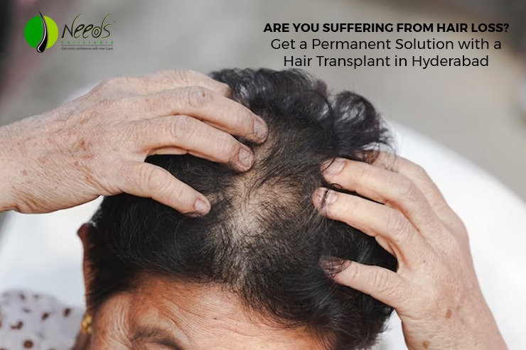 Are you suffering from hair loss? Get a Permanent Solution with a Hair Transplant in Hyderabad
