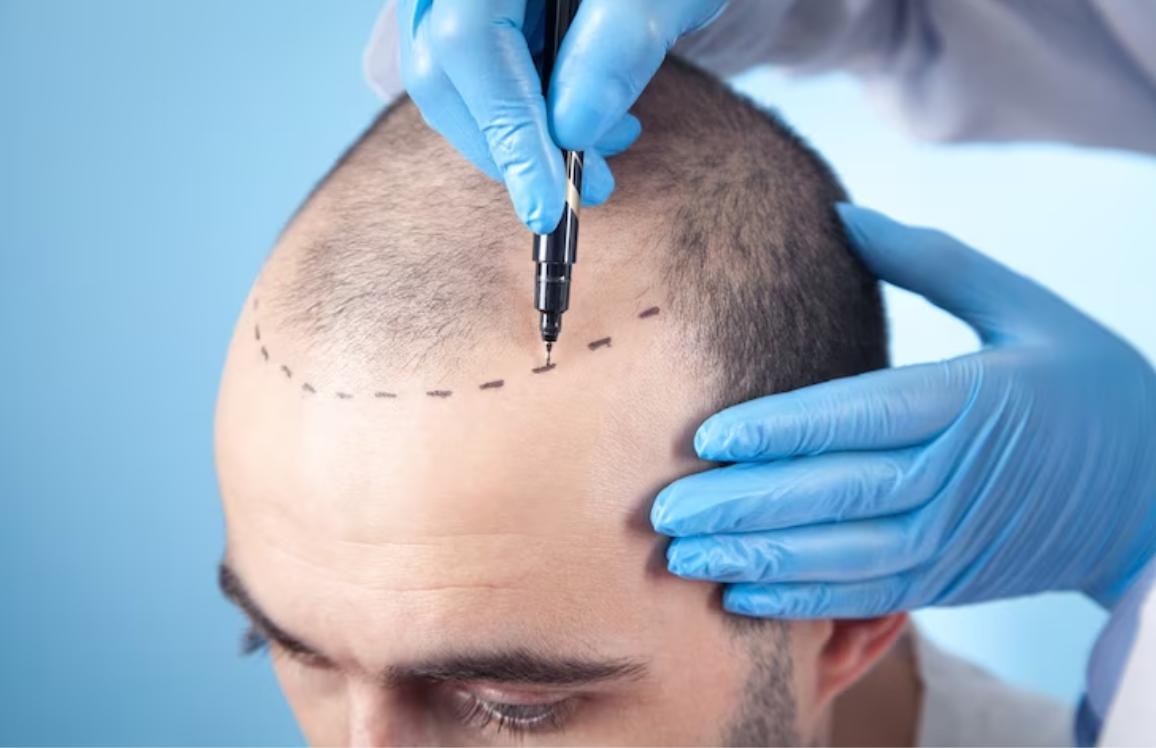 Hair Transplant Complications and Suggestions