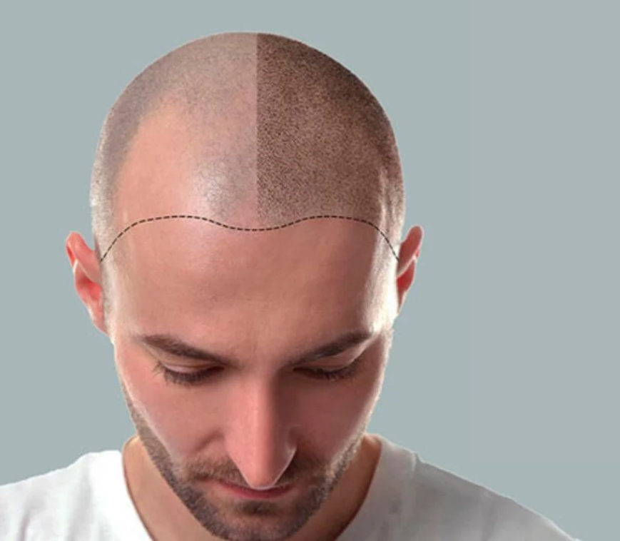 Who can benefit from scalp micro-pigmentation?