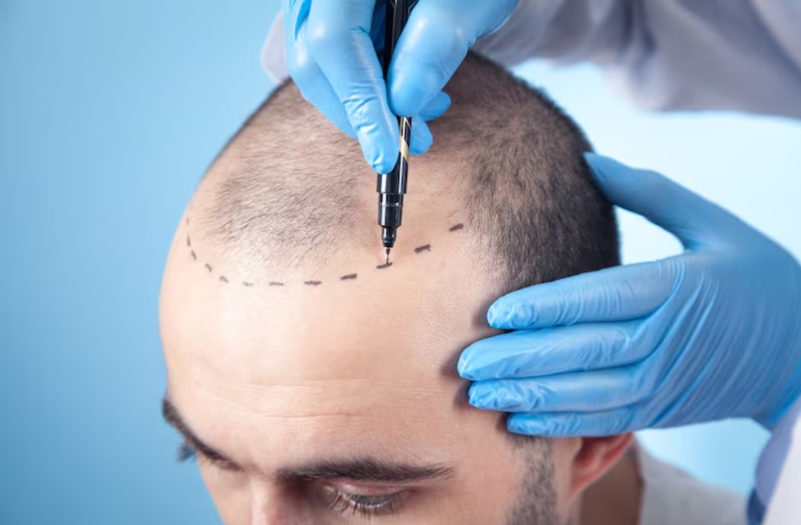 Potential Risks and Side Effects of Hair Transplantation