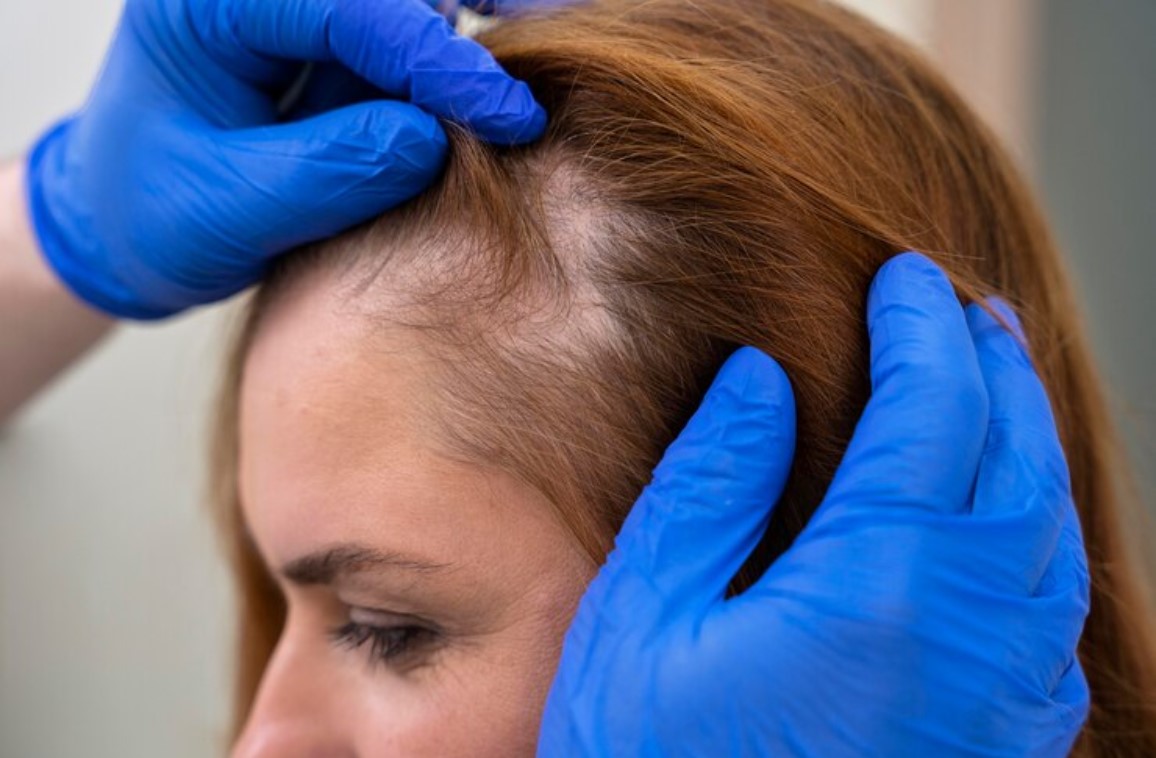 Follicular Unit Extraction for Women: Effective Hair Treatment 